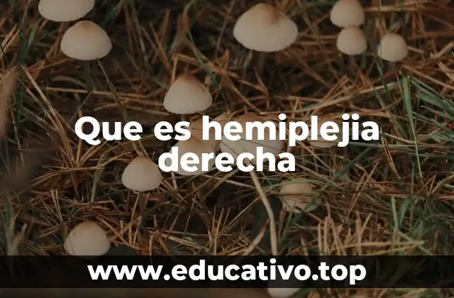 Que es hemiplejia derecha